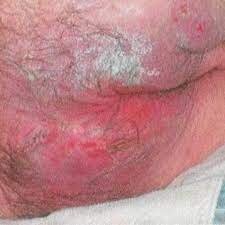 incontinence associated dermatitis