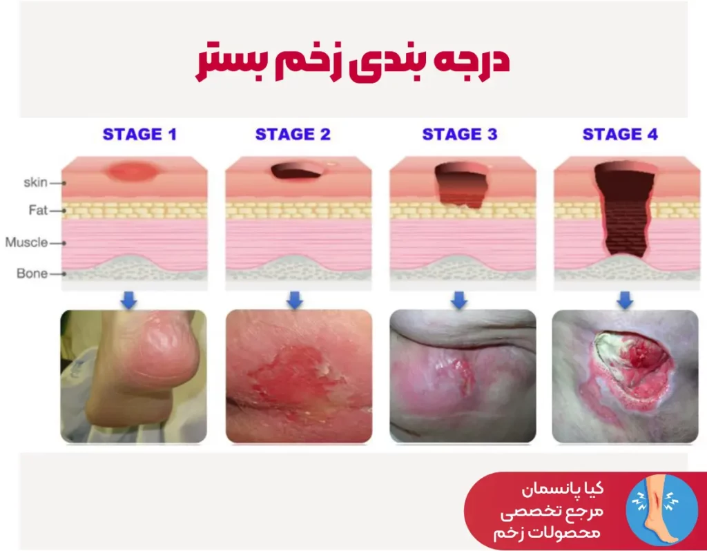 درجه بندی زخم بستر