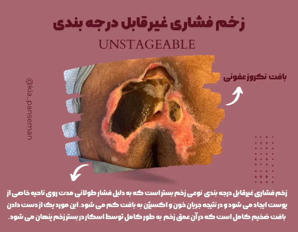 زخم فشاری غیرقابل درجه بندی یا Unstageable